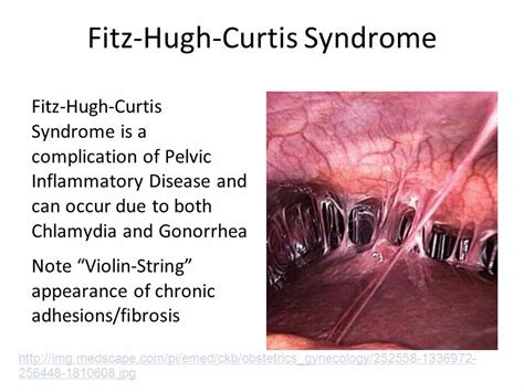 Fitz Hugh Curtis Syndrome .